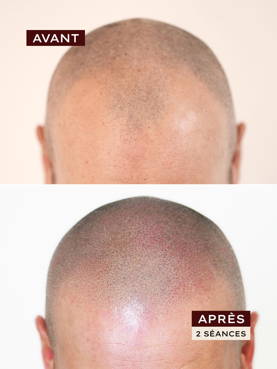 Avant / après · effet crâne rasé, 2 séances